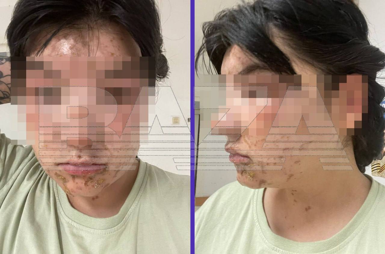Ожоги серной кислотой получила сотрудница племенного завода в Кобралово - Специалист получила химические ожоги головы, верхних конечностей, век и глаз.